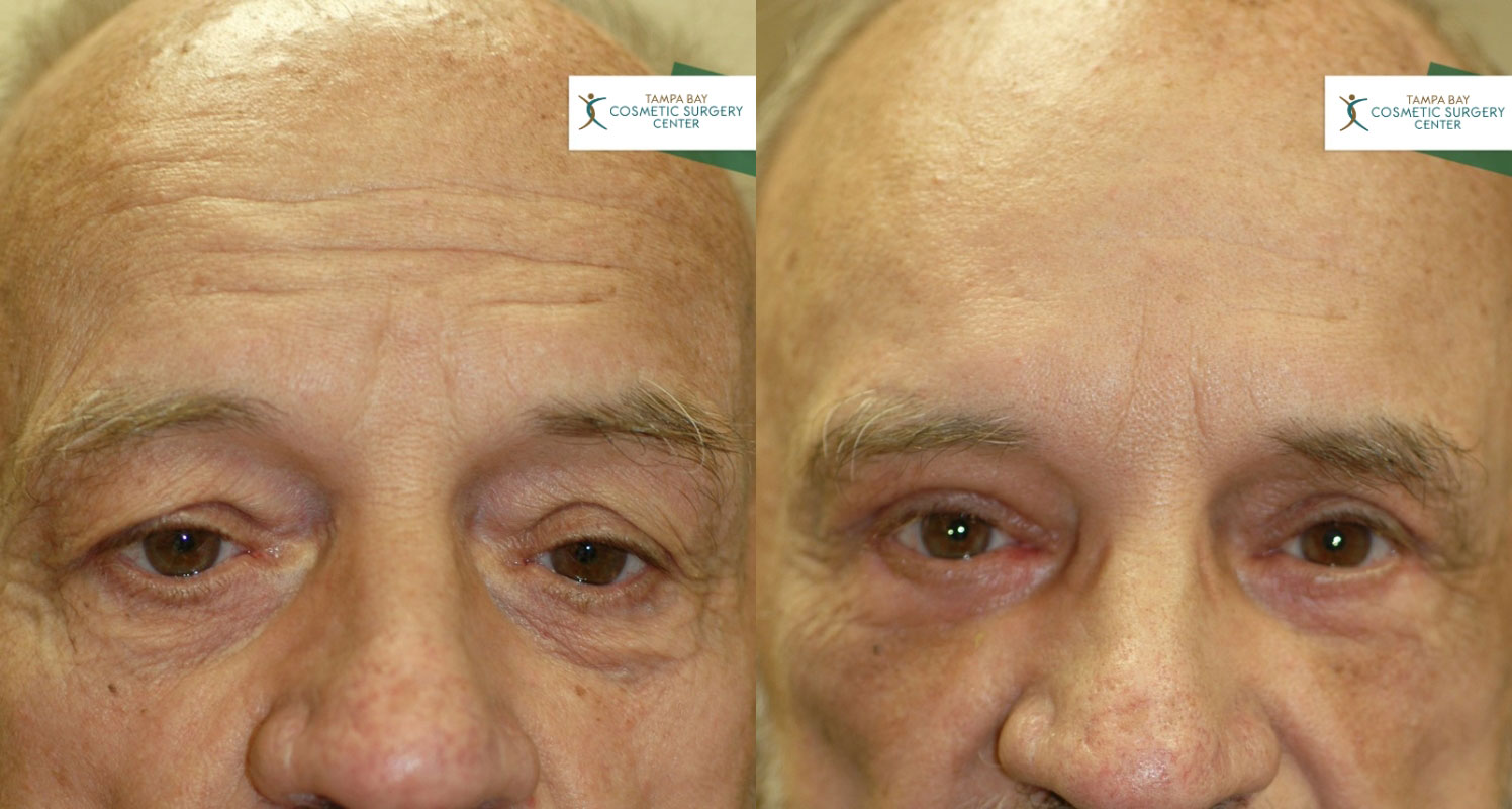 Close-up of Forehead after Lift Surgery