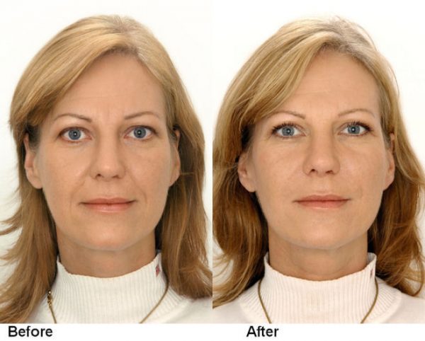 Restylane Facial Fillers In Tampa FL Kass Center For Cosmetic Surgery
