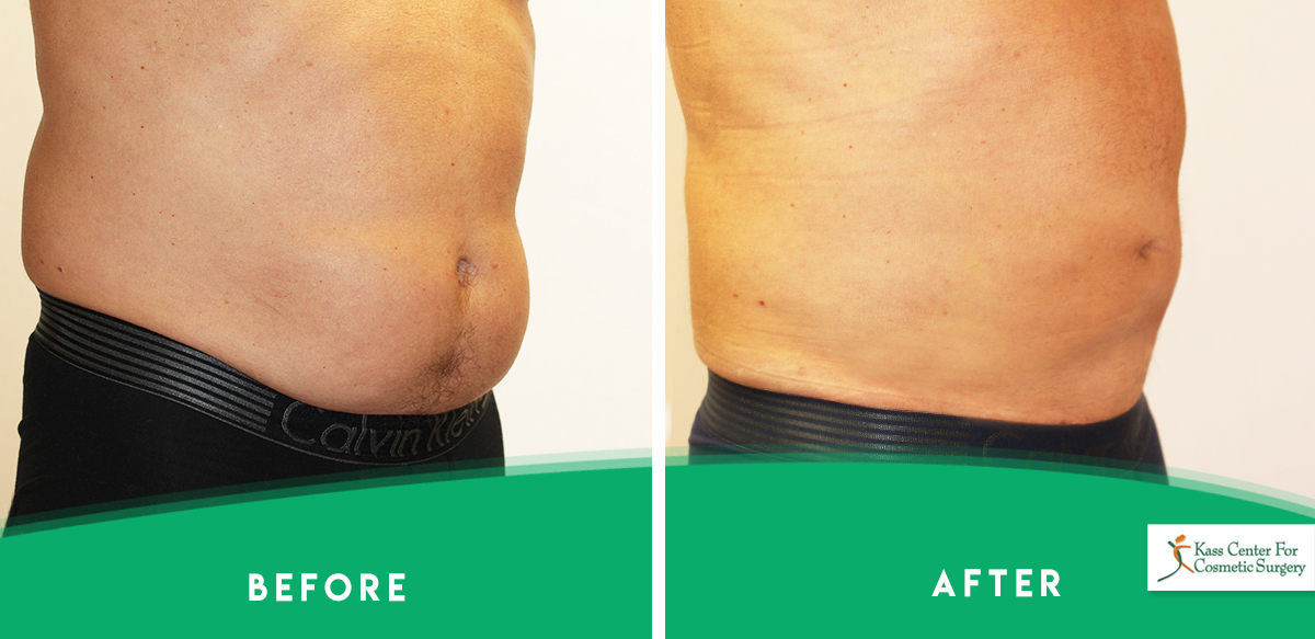 St. Petersburg & Clearwater Liposculpture Tampa Bay Cosmetic Surgery(02)